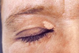 Xanthelasma - Quelle: GALENpharma